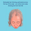 SAVE £5: Follicle Intense Defence Peptide & Caffeine Scalp Serum for acute hair thinning across the scalp 50ml - Hairfix