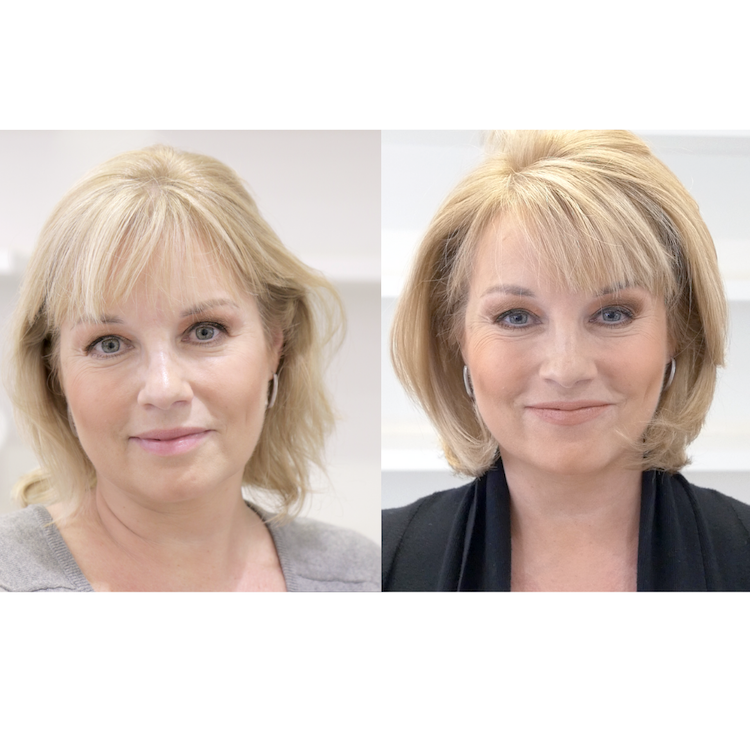 hair thinning treatments for women