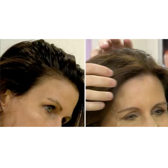 hair loss reversal treatment uk