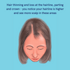 vegan hair loss treatment 