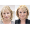 hair thinning treatments for women
