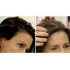 hair loss reversal treatment uk 
