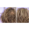 thinning hair treatments for women 