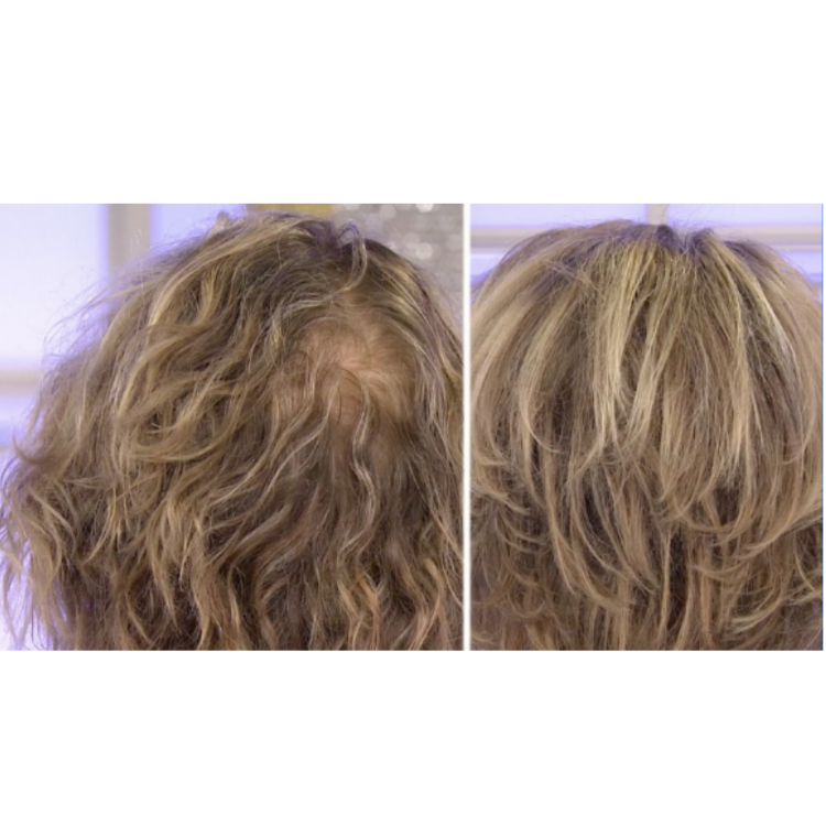 hair loss and thinning at crown women 